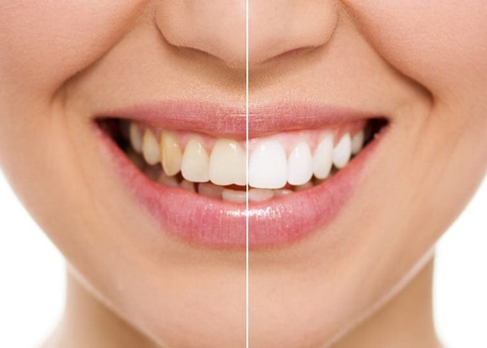 whitening